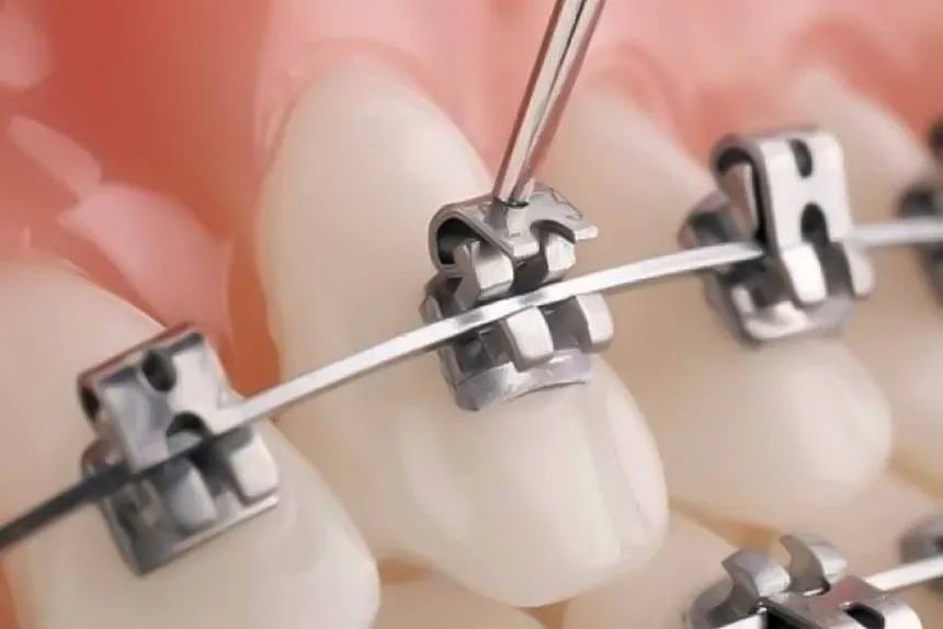 Brackets de Autoligado