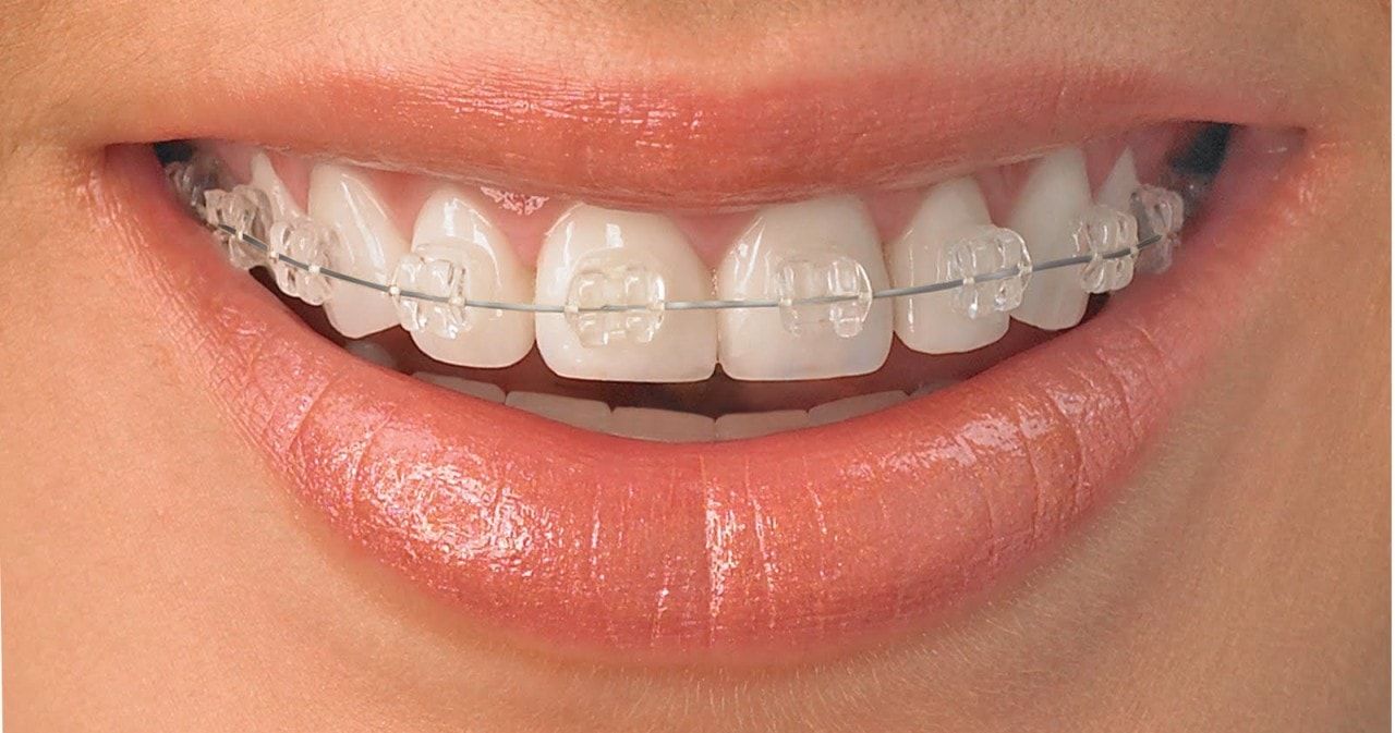 Brackets Estéticos