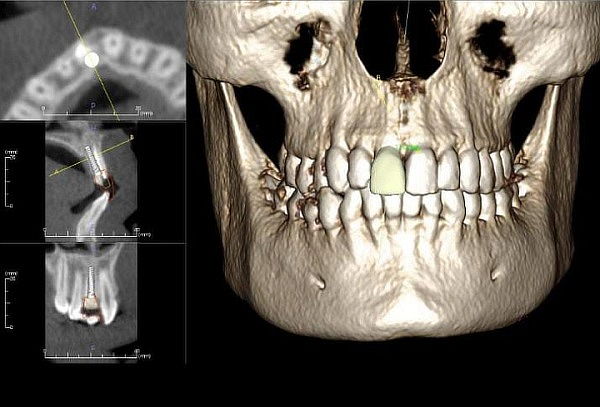 Tomografía 3D