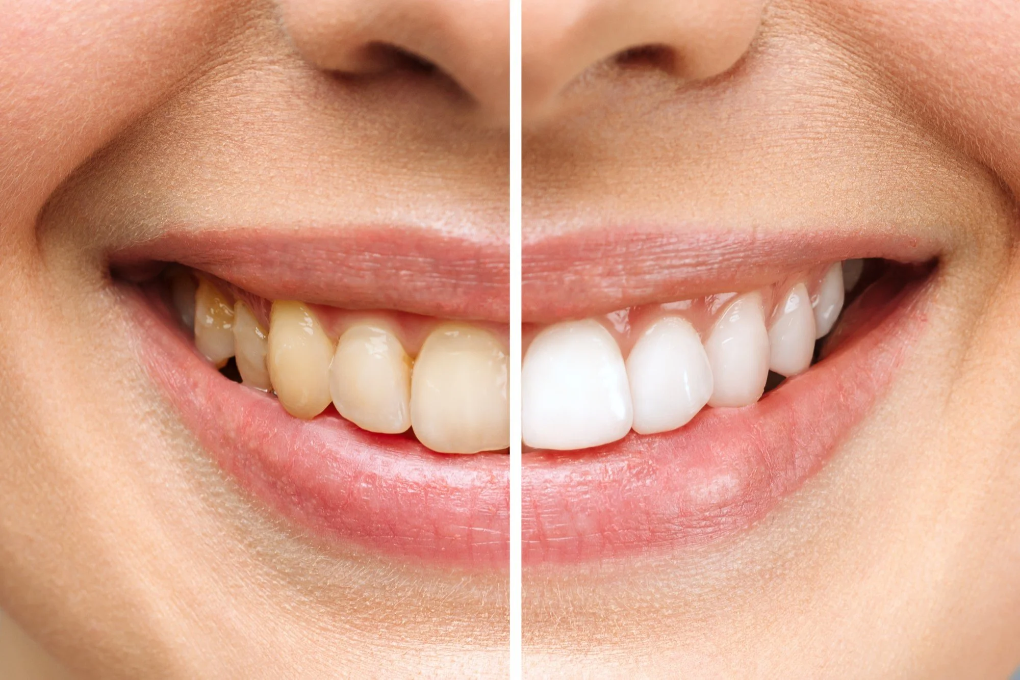 Aclaramiento Dental
