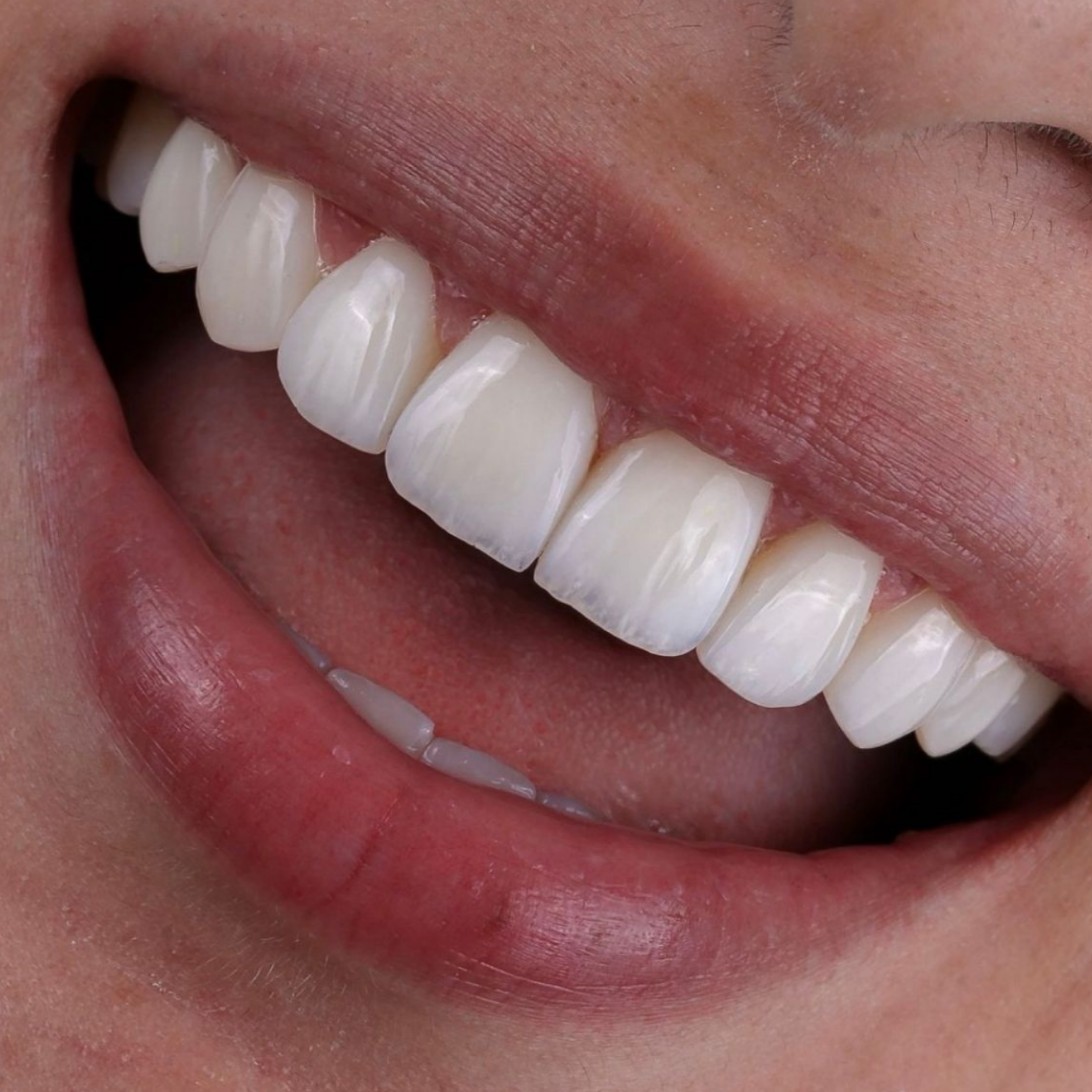 Diseño de Sonrisas