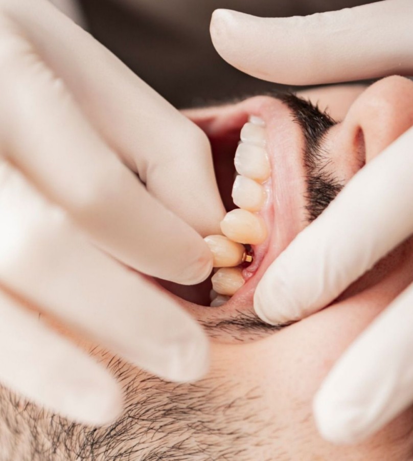 Implantes Dentales